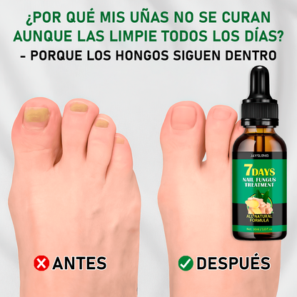 TRATAMIENTO ANTI HONGOS 7 DÍAS 100% NATURAL 2x1
